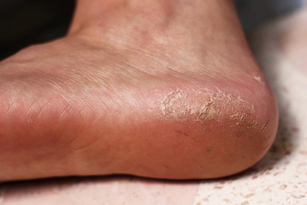 Calluses  Chino Hills, CA