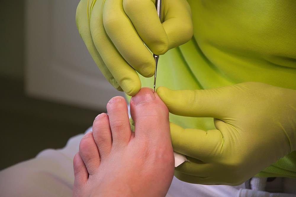 Ingrown Toenails  Chino Hills, CA