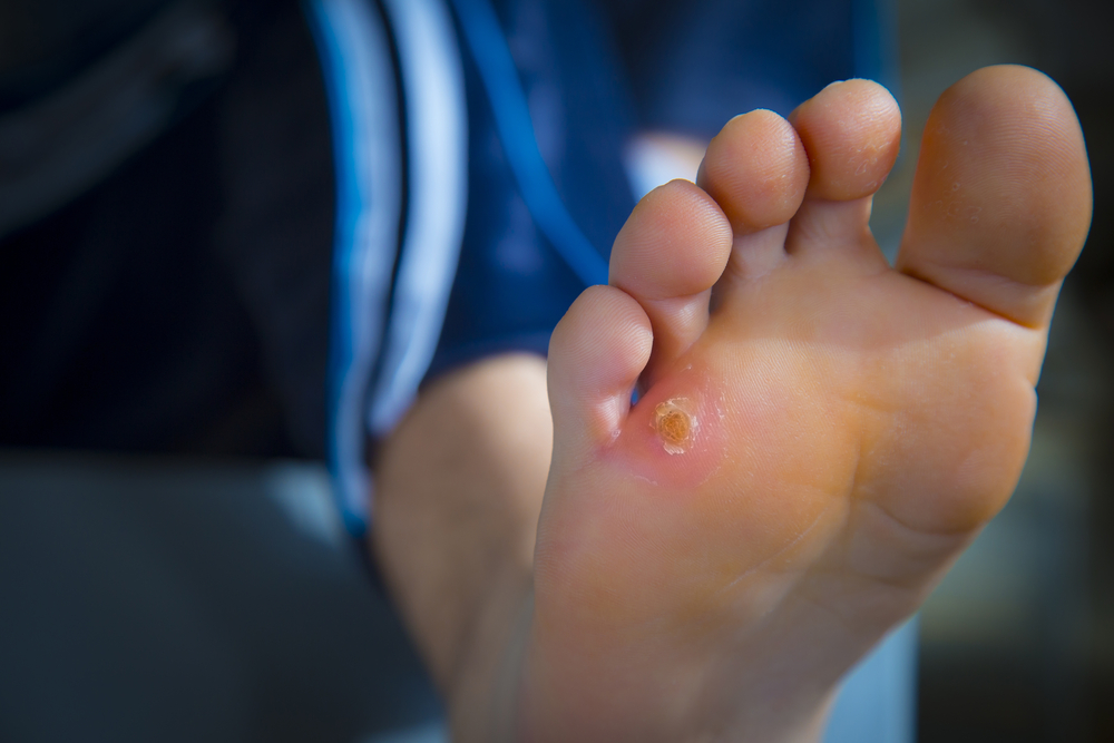 Wound Care  Chino Hills, CA